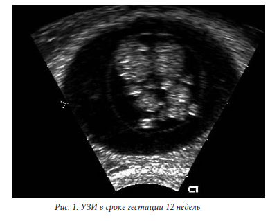 Беременность 12 Недель Двойня Фото Узи